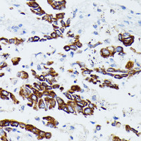 Immunohistochemistry of paraffin-embedded Human lung cancer using MMP25 Polyclonal Antibody at dilution of 1:100 (40x lens) .