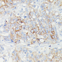 Immunohistochemistry of paraffin-embedded Human lymph node tumors using SLC14A1 Polyclonal Antibody at dilution of 1:100 (40x lens) .