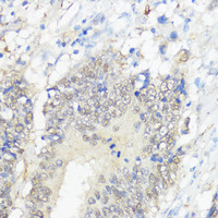 Immunohistochemistry of paraffin-embedded Human colon carcinoma using GPX2 Polyclonal Antibody at dilution of 1:100 (40x lens) .