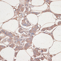 Immunohistochemistry of paraffin-embedded Human breast cancer using LAMC1 Polyclonal Antibody at dilution of 1:100 (40x lens) .