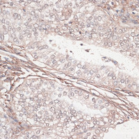 Immunohistochemistry of paraffin-embedded Human uterine cancer using LAMC1 Polyclonal Antibody at dilution of 1:100 (40x lens) .