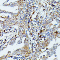 Immunohistochemistry of paraffin-embedded Human lung cancer using MAP3K3 Polyclonal Antibody at dilution of 1:100 (40x lens) .