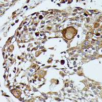 Immunohistochemistry of paraffin-embedded Human esophageal cancer using MAP3K3 Polyclonal Antibody at dilution of 1:100 (40x lens) .