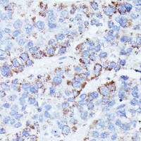 Immunohistochemistry of paraffin-embedded Human liver cancer using CCDC6 Polyclonal Antibody at dilution of 1:100 (40x lens) .