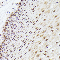 Immunohistochemistry of paraffin-embedded Human esophageal using MLF2 Polyclonal Antibody at dilution of 1:100 (40x lens) .