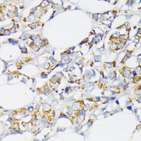 Immunohistochemistry of paraffin-embedded Human breast cancer using USP33 Polyclonal Antibody at dilution of 1:100 (40x lens) .