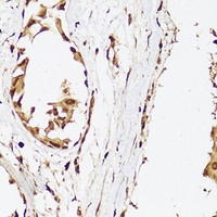 Immunohistochemistry of paraffin-embedded Human breast cancer using Androgen Receptor Polyclonal Antibody at dilution of 1:150 (40x lens) .