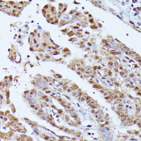 Immunohistochemistry of paraffin-embedded Human thyroid cancer using KIAA1429 Polyclonal Antibody at dilution of 1:100 (40x lens) .