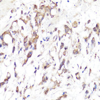 Immunohistochemistry of paraffin-embedded Human gastric cancer using SELL Polyclonal Antibody at dilution of 1:100 (40x lens) .