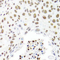 Immunohistochemistry of paraffin-embedded Human lung cancer using CDX2 Polyclonal Antibody at dilution of 1:100 (40x lens) .