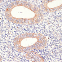 Immunohistochemistry of paraffin-embedded Human uterine cancer using HMGCR Polyclonal Antibody at dilution of 1:200 (40x lens) .