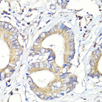 Immunohistochemistry of paraffin-embedded Human colon carcinoma using HBEGF Polyclonal Antibody at dilution of 1:100 (40x lens) .