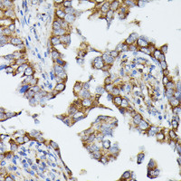 Immunohistochemistry of paraffin-embedded Human lung cancer using MTIF2 Polyclonal Antibody at dilution of 1:100 (40x lens) .