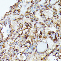 Immunohistochemistry of paraffin-embedded Human thyroid cancer using NUBP1 Polyclonal Antibody at dilution of 1:100 (40x lens) .