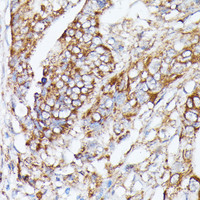 Immunohistochemistry of paraffin-embedded Human colon carcinoma using NUBP1 Polyclonal Antibody at dilution of 1:100 (40x lens) .