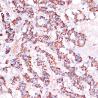 Immunohistochemistry of paraffin-embedded Human thyroid cancer using MRPL23 Polyclonal Antibody at dilution of 1:100 (40x lens) .