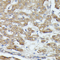 Immunohistochemistry of paraffin-embedded Human liver cancer using SAA4 Polyclonal Antibody at dilution of 1:100 (40x lens) .