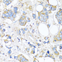 Immunohistochemistry of paraffin-embedded Human breast cancer using TIMP2 Polyclonal Antibody at dilution of 1:150 (40x lens) .