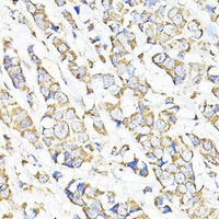 Immunohistochemistry of paraffin-embedded Human breast cancer using TGFB1 Polyclonal Antibody at dilution of 1:100 (40x lens) .