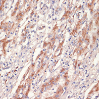 Immunohistochemistry of paraffin-embedded Human liver cancer using AMPKα1 Polyclonal Antibody at dilution of 1:200 (40x lens) .