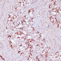 Immunohistochemistry of paraffin-embedded Human oophoroma using UGT2B15 Polyclonal Antibody at dilution of 1:100 (40x lens) .