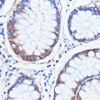 Immunohistochemistry of paraffin-embedded Human colon carcinoma using ATXN2 Polyclonal Antibody at dilution of 1:100 (40x lens) .
