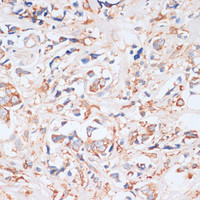 Immunohistochemistry of paraffin-embedded Human breast cancer using EIF4EBP1 Polyclonal Antibody at dilution of 1:100 (40x lens) .