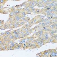 Immunohistochemistry of paraffin-embedded Human liver cancer using ASGR1 Polyclonal Antibody at dilution of 1:100 (40x lens) .