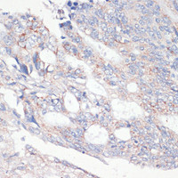 Immunohistochemistry of paraffin-embedded Human colon carcinoma using Bcl-2 Polyclonal Antibody at dilution of 1:200 (40x lens) .