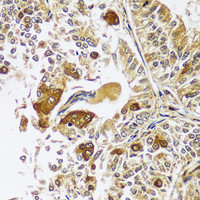 Immunohistochemistry of paraffin-embedded Human uterine cancer using CAST Polyclonal Antibody at dilution of 1:100 (40x lens) .