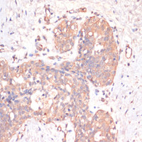 Immunohistochemistry of paraffin-embedded Human mammary cancer using Caspase-3 Polyclonal Antibody at dilution of 1:200 (40x lens) .