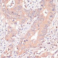 Immunohistochemistry of paraffin-embedded Human colon carcinoma using Caspase-3 Polyclonal Antibody at dilution of 1:200 (40x lens) .