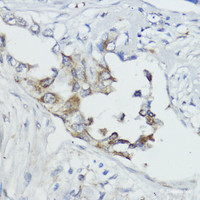 Immunohistochemistry of paraffin-embedded Human lung cancer using FXN Polyclonal Antibody at dilution of 1:100 (40x lens) .