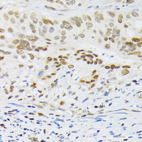Immunohistochemistry of paraffin-embedded Human colon carcinoma using HIF1A Polyclonal Antibody at dilution of 1:200 (40x lens) .
