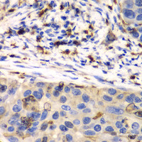 Immunohistochemistry of paraffin-embedded Human esophageal cancer using S100A8 Polyclonal Antibody at dilution of 1:100 (40x lens) .