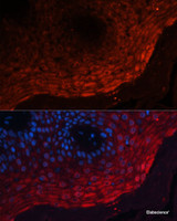 Immunofluorescence analysis of Human skin cancer using S100A8 Polyclonal Antibody at dilution of 1:100 (40x lens) . Blue: DAPI for nuclear staining.