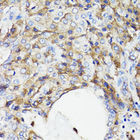 Immunohistochemistry of paraffin-embedded Human lung cancer using CD59 Polyclonal Antibody at dilution of 1:100 (40x lens) .