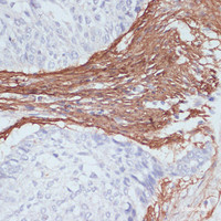 Immunohistochemistry of paraffin-embedded Human lung cancer using COL1A1 Polyclonal Antibody at dilution of 1:200 (40x lens) .