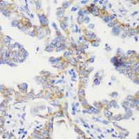 Immunohistochemistry of paraffin-embedded Human lung cancer using TOM20 Polyclonal Antibody at dilution of 1:100 (40x lens) .