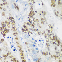 Immunohistochemistry of paraffin-embedded Human colon carcinoma using p53 Polyclonal Antibody at dilution of 1:200 (40x lens) .