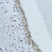 Immunohistochemistry of paraffin-embedded Human mammary cancer using NR1I3 Polyclonal Antibody at dilution of 1:200 (40x lens) .