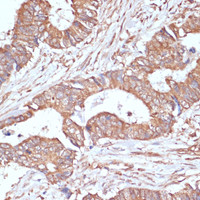 Immunohistochemistry of paraffin-embedded Human colon carcinoma using YAP1 Polyclonal Antibody at dilution of 1:100 (40x lens) .