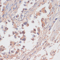 Immunohistochemistry of paraffin-embedded Human lung cancer using NCSTN Polyclonal Antibody at dilution of 1:100 (40x lens) .