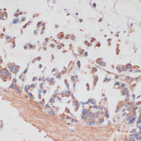 Immunohistochemistry of paraffin-embedded Human gastric cancer using NCSTN Polyclonal Antibody at dilution of 1:100 (40x lens) .