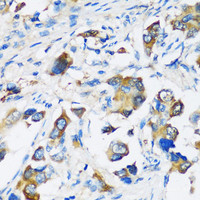 Immunohistochemistry of paraffin-embedded Human lung cancer using ARFIP2 Polyclonal Antibody at dilution of 1:100 (40x lens) .