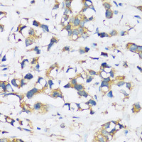 Immunohistochemistry of paraffin-embedded Human breast cancer using ARFIP2 Polyclonal Antibody at dilution of 1:100 (40x lens) .