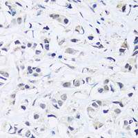 Immunohistochemistry of paraffin-embedded Human breast cancer using ARL6IP4 Polyclonal Antibody at dilution of 1:100 (40x lens) .