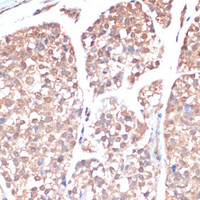 Immunohistochemistry of paraffin-embedded Human gastric cancer using PRMT7 Polyclonal Antibody at dilution of 1:200 (40x lens) .