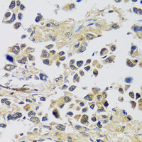 Immunohistochemistry of paraffin-embedded Human lung cancer using C12orf10 Polyclonal Antibody at dilution of 1:100 (40x lens) .