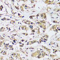 Immunohistochemistry of paraffin-embedded Human breast cancer using C12orf10 Polyclonal Antibody at dilution of 1:100 (40x lens) .